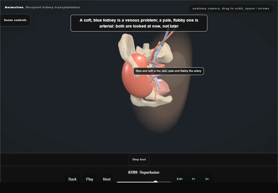 Recipient kidney transplantation. Step 7: Reperfusion. Captured frame from the interactive animation.
