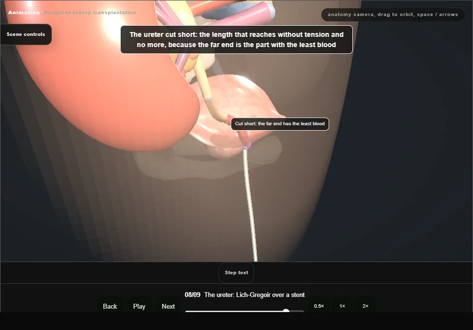 Recipient kidney transplantation. Step 8: The ureter: Lich-Gregoir over a stent. Captured frame from the interactive animation.
