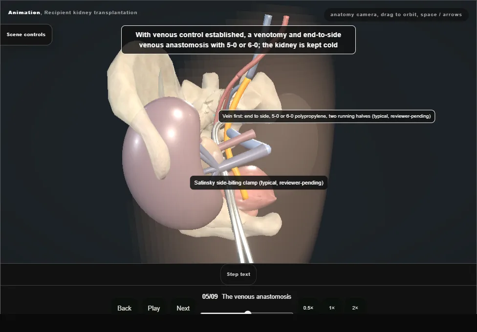 Recipient kidney transplantation. Step 5: The venous anastomosis. Captured frame from the interactive animation.
