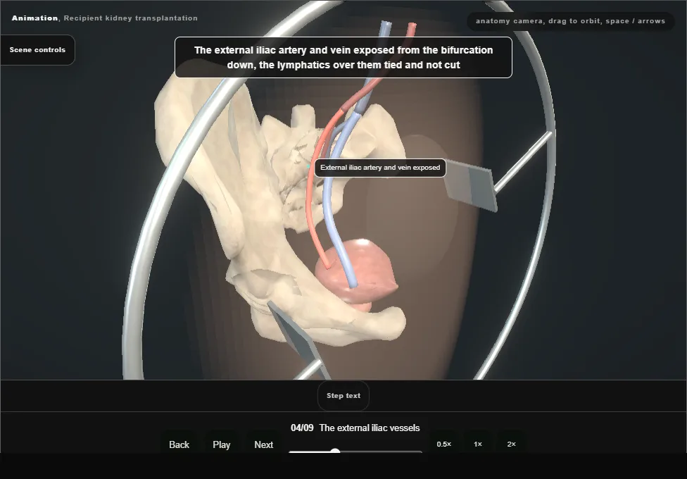 Recipient kidney transplantation. Step 4: The external iliac vessels. Captured frame from the interactive animation.