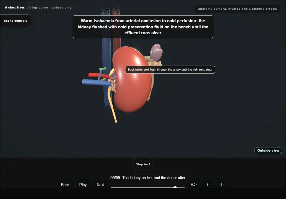 Living-donor nephrectomy. Step 9: The kidney on ice, and the donor after. Captured frame from the interactive animation.