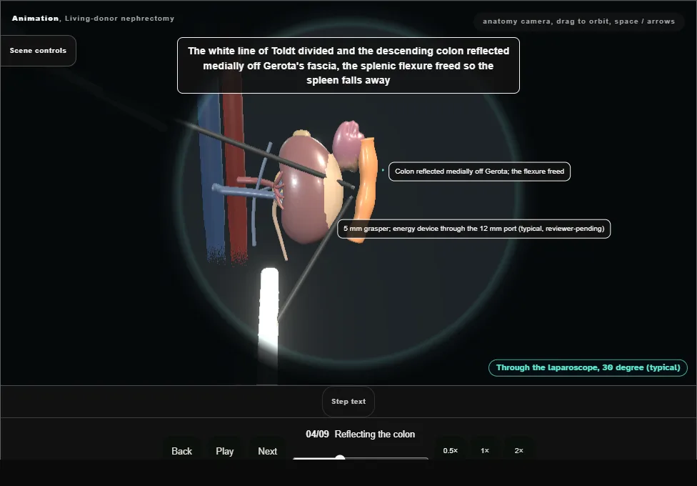Living-donor nephrectomy. Step 4: Reflecting the colon. Captured frame from the interactive animation.