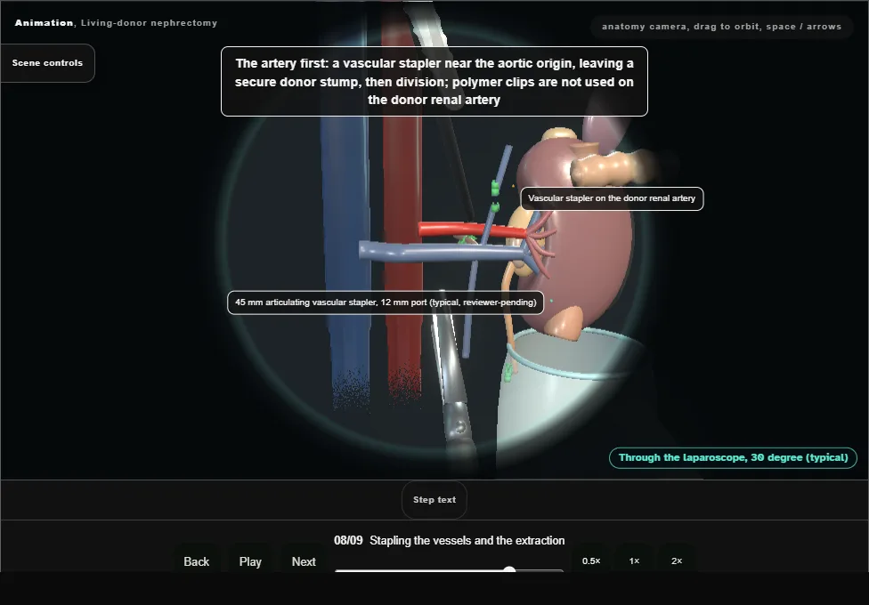Living-donor nephrectomy. Step 8: Stapling the vessels and the extraction. Captured frame from the interactive animation.