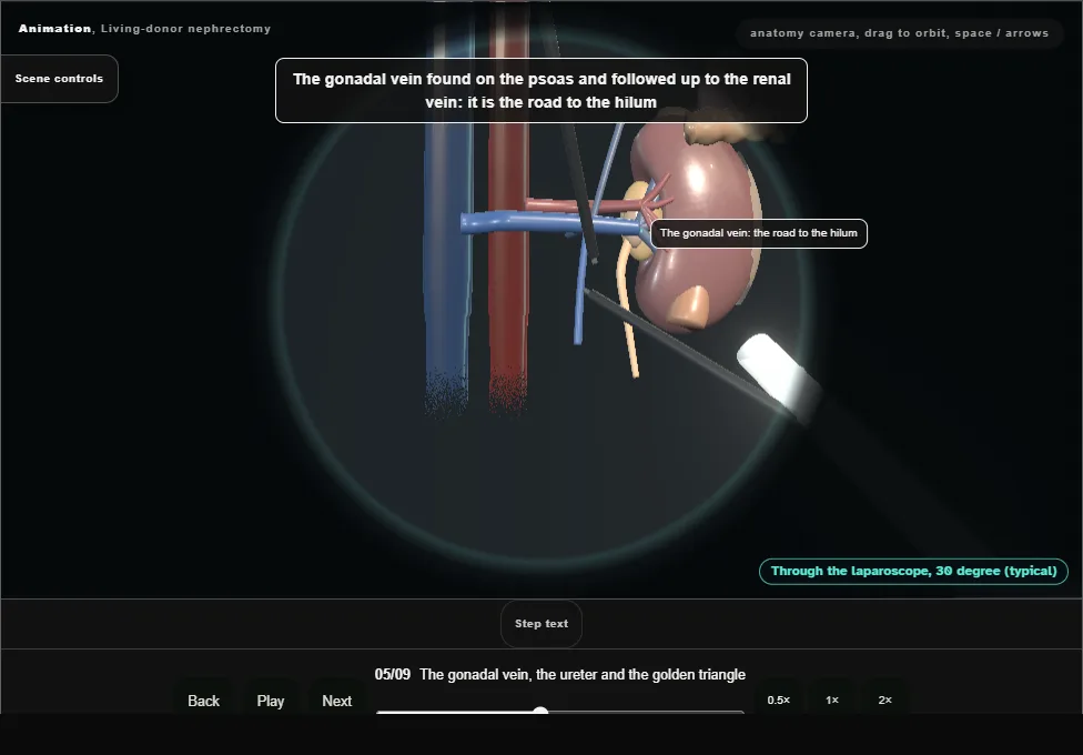 Living-donor nephrectomy. Step 5: The gonadal vein, the ureter and the golden triangle. Captured frame from the interactive animation.