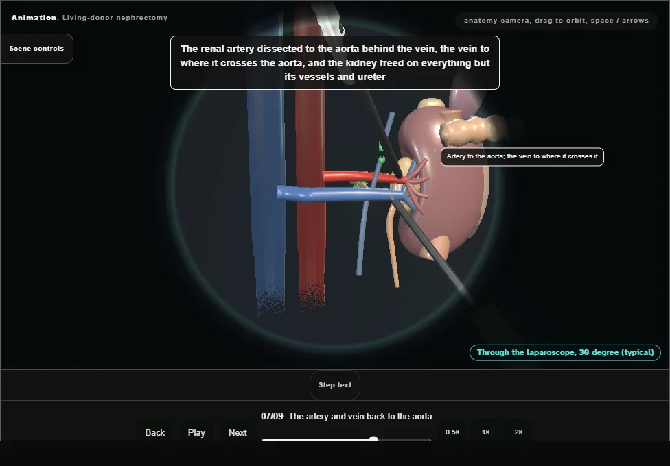 Living-donor nephrectomy. Step 7: The artery and vein back to the aorta. Captured frame from the interactive animation.