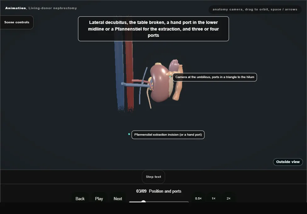 Living-donor nephrectomy. Step 3: Position and ports. Captured frame from the interactive animation.