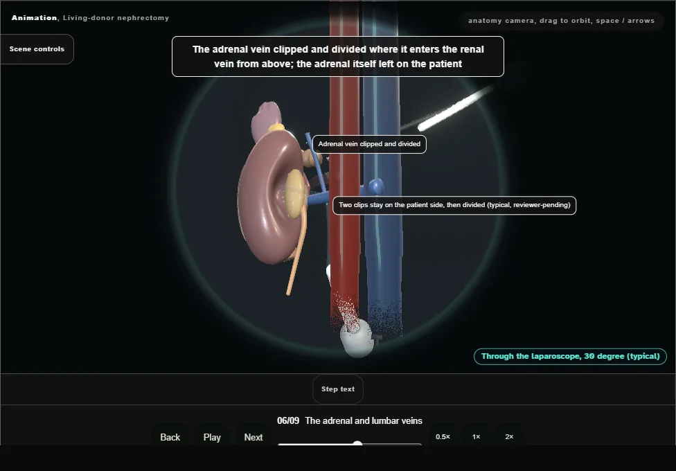 Living-donor nephrectomy. Step 6: The adrenal and lumbar veins. Captured frame from the interactive animation.
