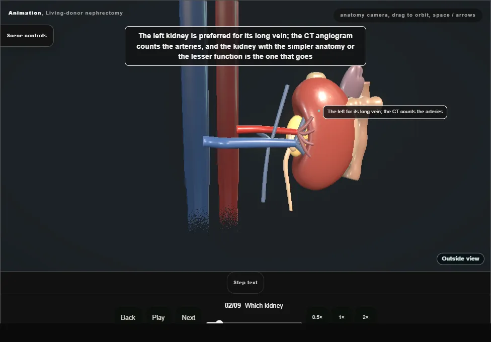 Living-donor nephrectomy. Step 2: Which kidney. Captured frame from the interactive animation.