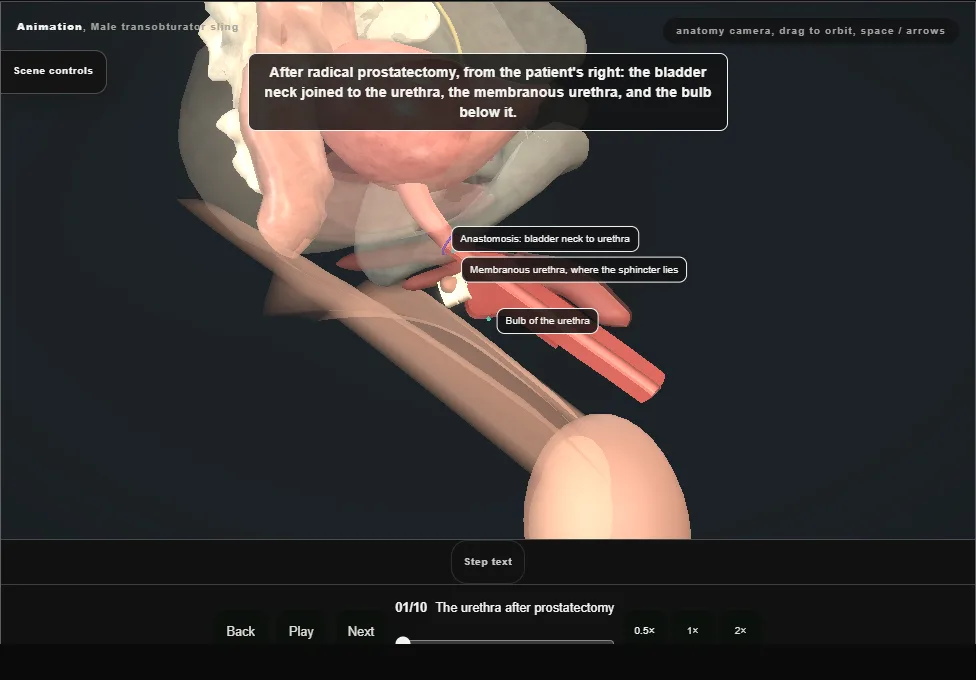 Male transobturator sling. Step 1: The urethra after prostatectomy. Captured frame from the interactive animation.