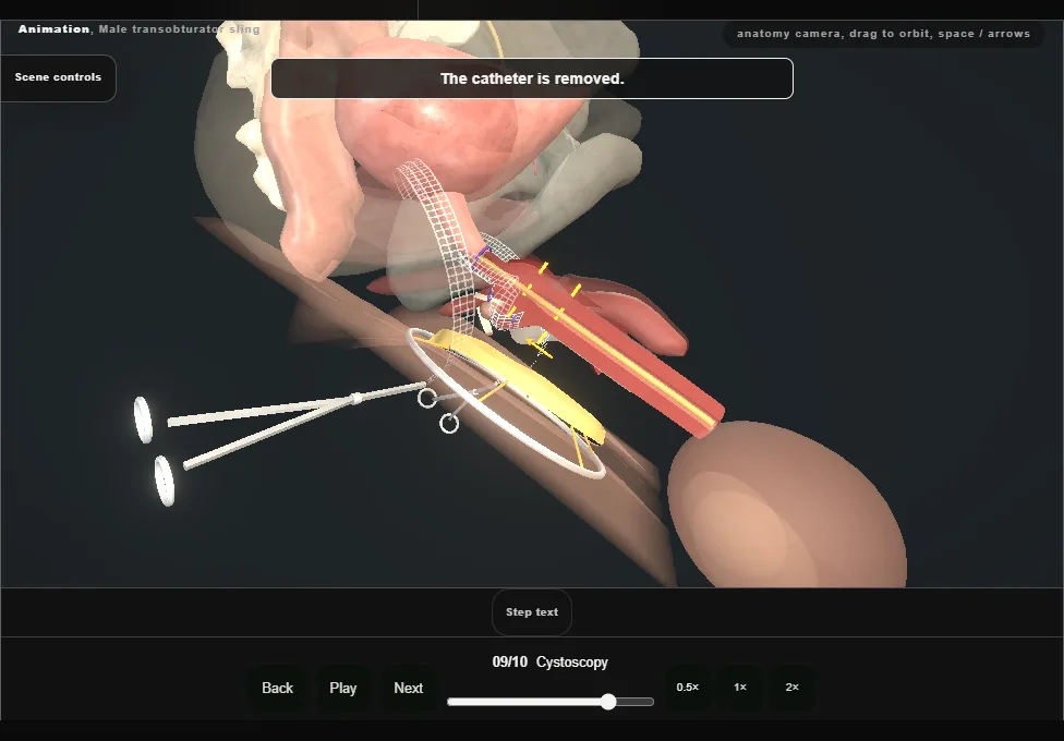 Male transobturator sling. Step 9: Cystoscopy. Captured frame from the interactive animation.