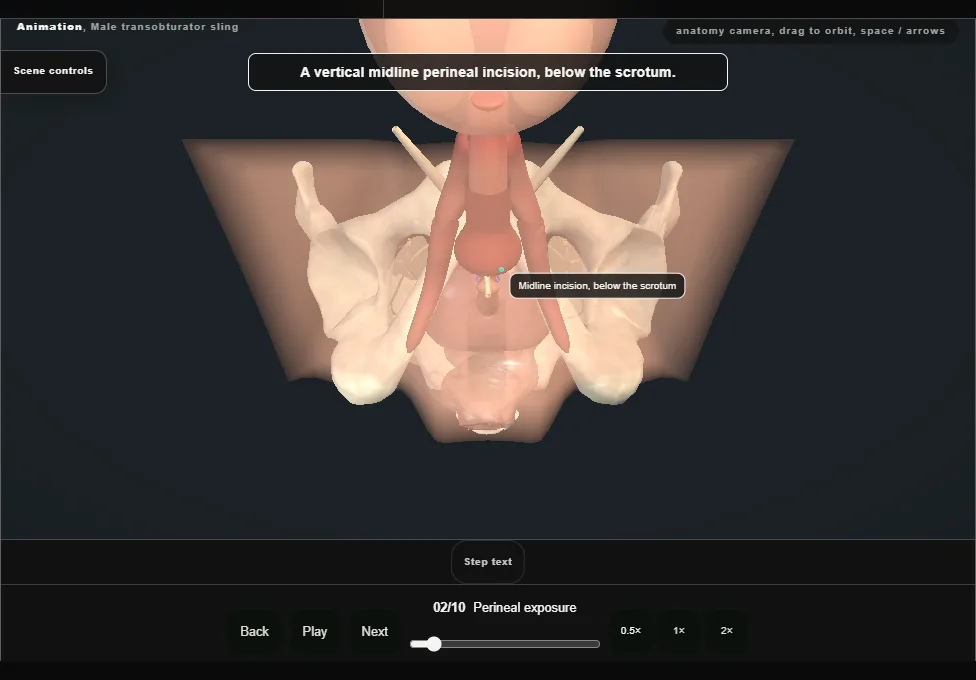 Male transobturator sling. Step 2: Perineal exposure. Captured frame from the interactive animation.
