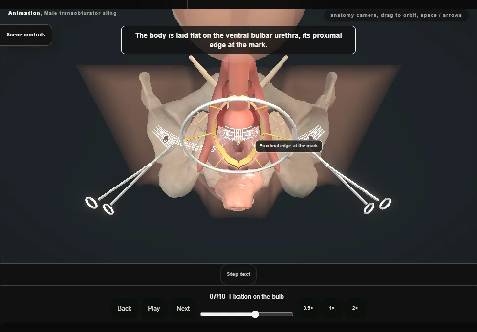Male transobturator sling. Step 7: Fixation on the bulb. Captured frame from the interactive animation.