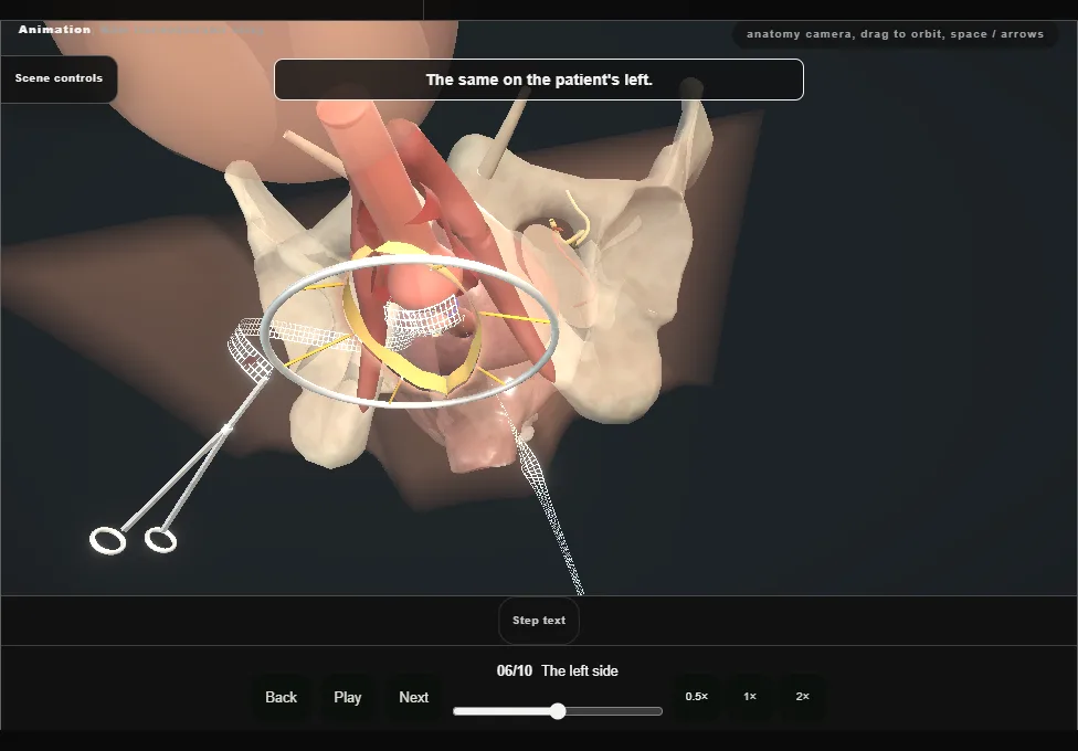 Male transobturator sling. Step 6: The left side. Captured frame from the interactive animation.