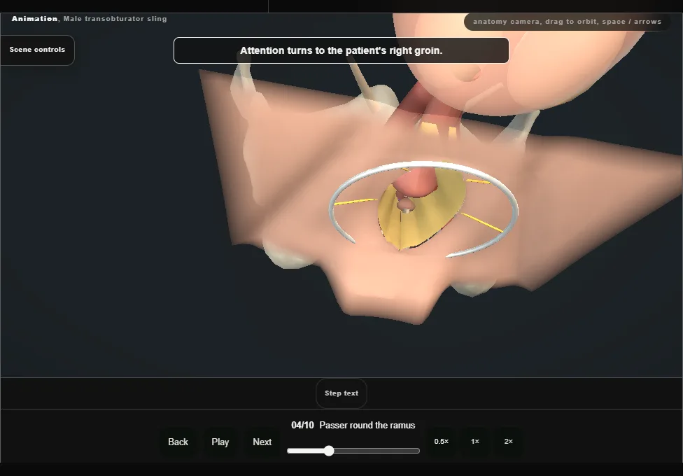 Male transobturator sling. Step 4: Passer round the ramus. Captured frame from the interactive animation.