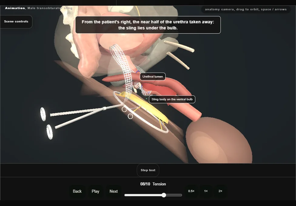 Male transobturator sling. Step 8: Tension. Captured frame from the interactive animation.