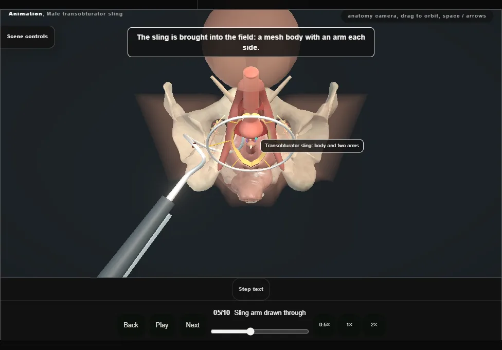 Male transobturator sling. Step 5: Sling arm drawn through. Captured frame from the interactive animation.