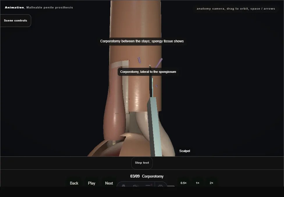 Malleable penile prosthesis. Step 3: Corporotomy. Captured frame from the interactive animation.