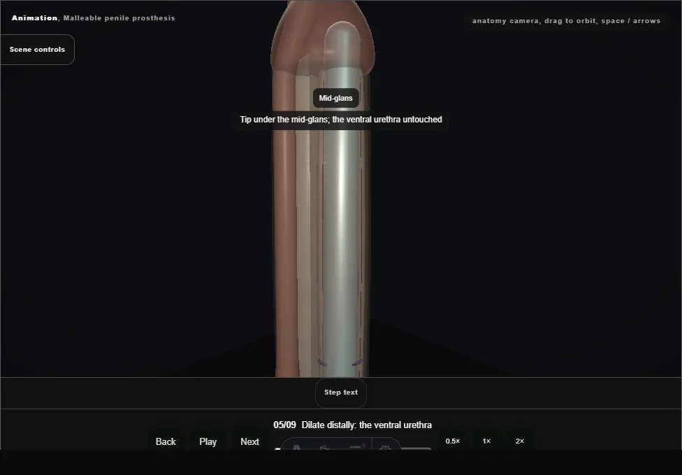 Malleable penile prosthesis. Step 5: Dilate distally: the ventral urethra. Captured frame from the interactive animation.