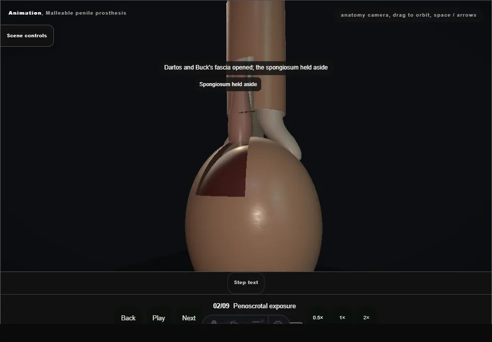 Malleable penile prosthesis. Step 2: Penoscrotal exposure. Captured frame from the interactive animation.