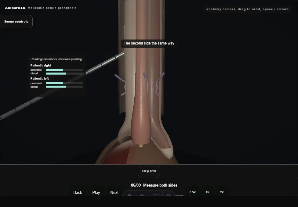 Malleable penile prosthesis. Step 6: Measure both sides. Captured frame from the interactive animation.