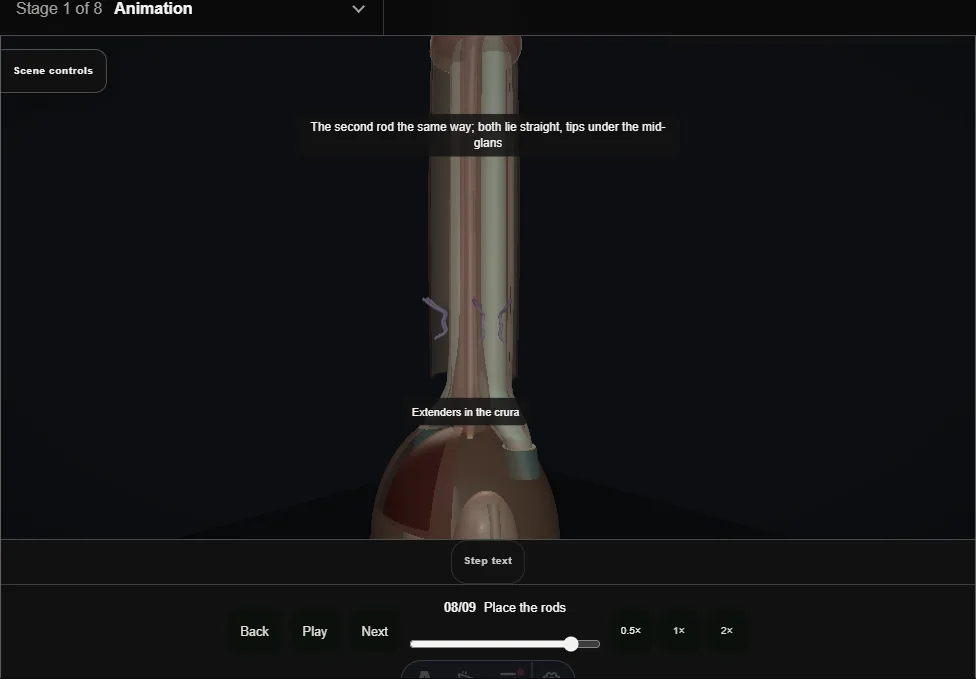 Malleable penile prosthesis. Step 8: Place the rods. Captured frame from the interactive animation.