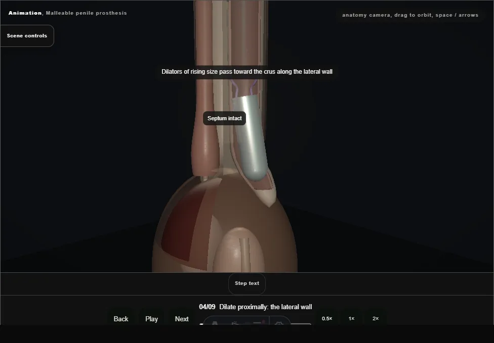 Malleable penile prosthesis. Step 4: Dilate proximally: the lateral wall. Captured frame from the interactive animation.