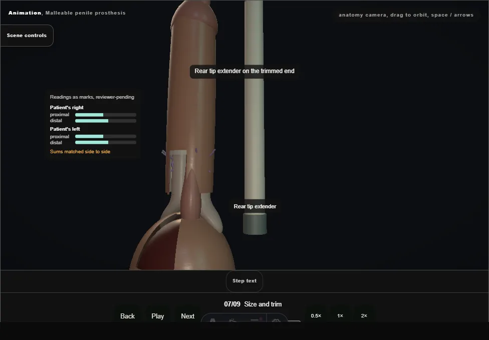 Malleable penile prosthesis. Step 7: Size and trim. Captured frame from the interactive animation.