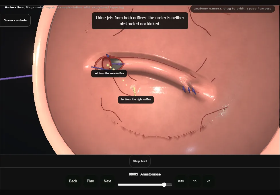Megaureter repair: reimplantation with excisional tapering. Step 8: Anastomose. Captured frame from the interactive animation.