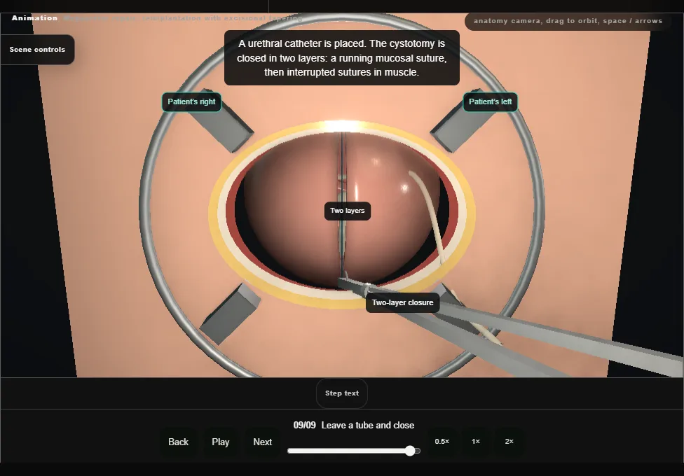 Megaureter repair: reimplantation with excisional tapering. Step 9: Leave a tube and close. Captured frame from the interactive animation.