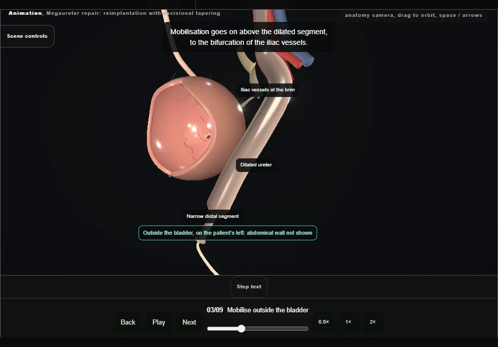 Megaureter repair: reimplantation with excisional tapering. Step 3: Mobilise outside the bladder. Captured frame from the interactive animation.