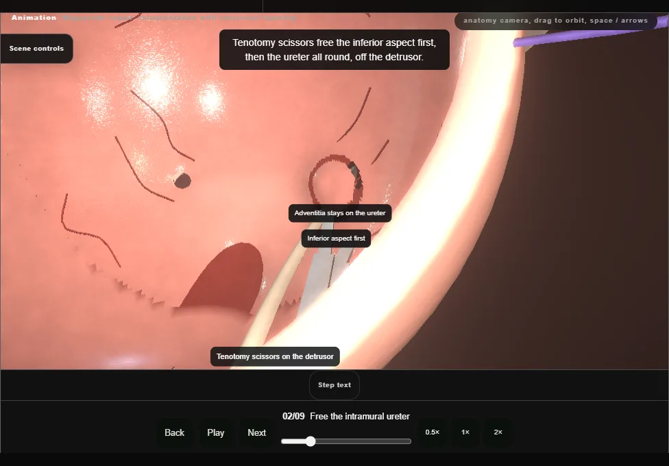 Megaureter repair: reimplantation with excisional tapering. Step 2: Free the intramural ureter. Captured frame from the interactive animation.
