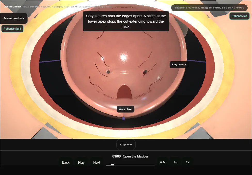 Megaureter repair: reimplantation with excisional tapering. Step 1: Open the bladder. Captured frame from the interactive animation.
