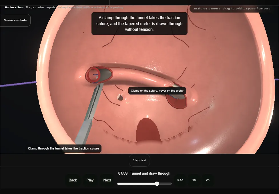 Megaureter repair: reimplantation with excisional tapering. Step 7: Tunnel and draw through. Captured frame from the interactive animation.