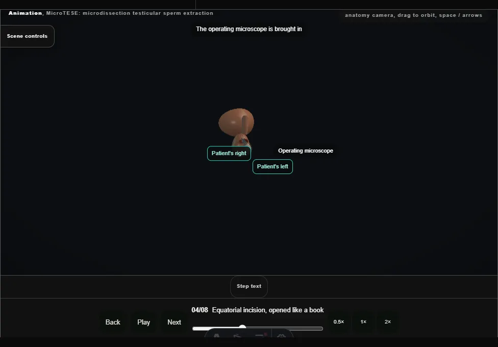 MicroTESE: microdissection testicular sperm extraction. Step 4: Equatorial incision, opened like a book. Captured frame from the interactive animation.