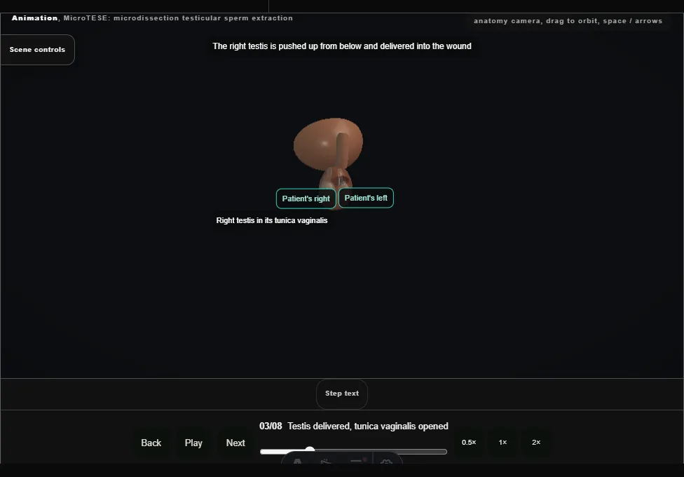 MicroTESE: microdissection testicular sperm extraction. Step 3: Testis delivered, tunica vaginalis opened. Captured frame from the interactive animation.