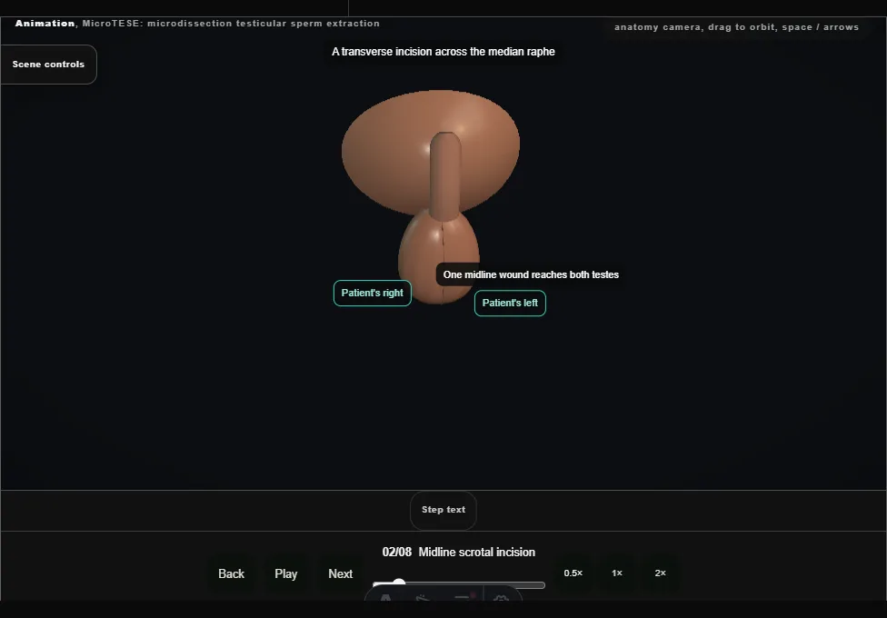 MicroTESE: microdissection testicular sperm extraction. Step 2: Midline scrotal incision. Captured frame from the interactive animation.