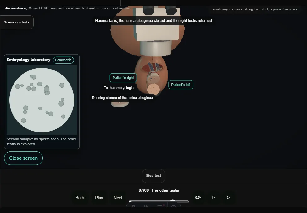 MicroTESE: microdissection testicular sperm extraction. Step 7: The other testis. Captured frame from the interactive animation.