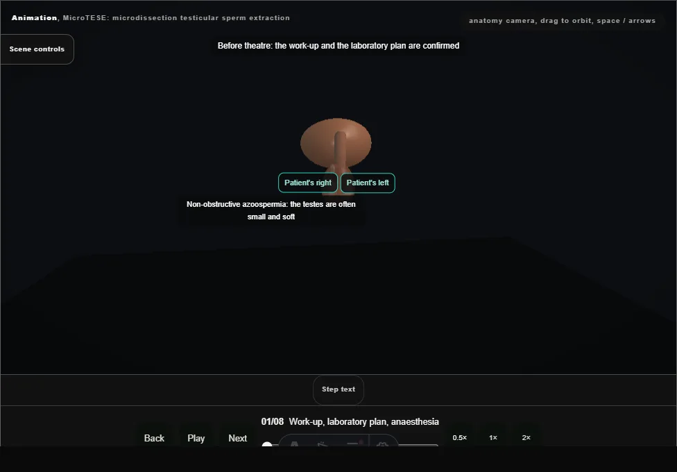 MicroTESE: microdissection testicular sperm extraction. Step 1: Work-up, laboratory plan, anaesthesia. Captured frame from the interactive animation.