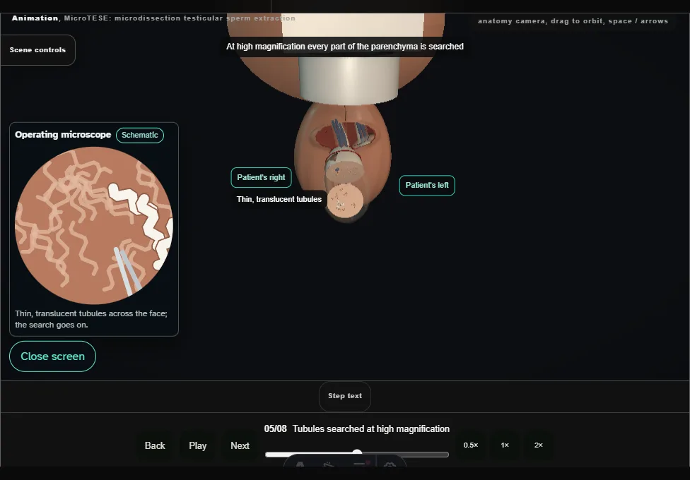 MicroTESE: microdissection testicular sperm extraction. Step 5: Tubules searched at high magnification. Captured frame from the interactive animation.