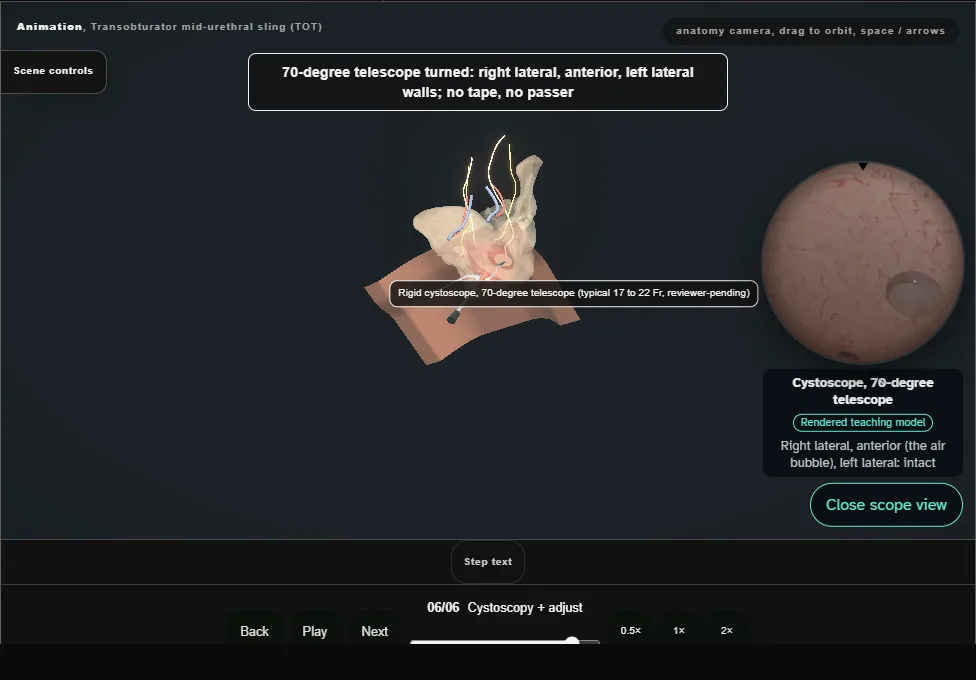 Transobturator mid-urethral sling (TOT). Step 6: Cystoscopy + adjust. Captured frame from the interactive animation.