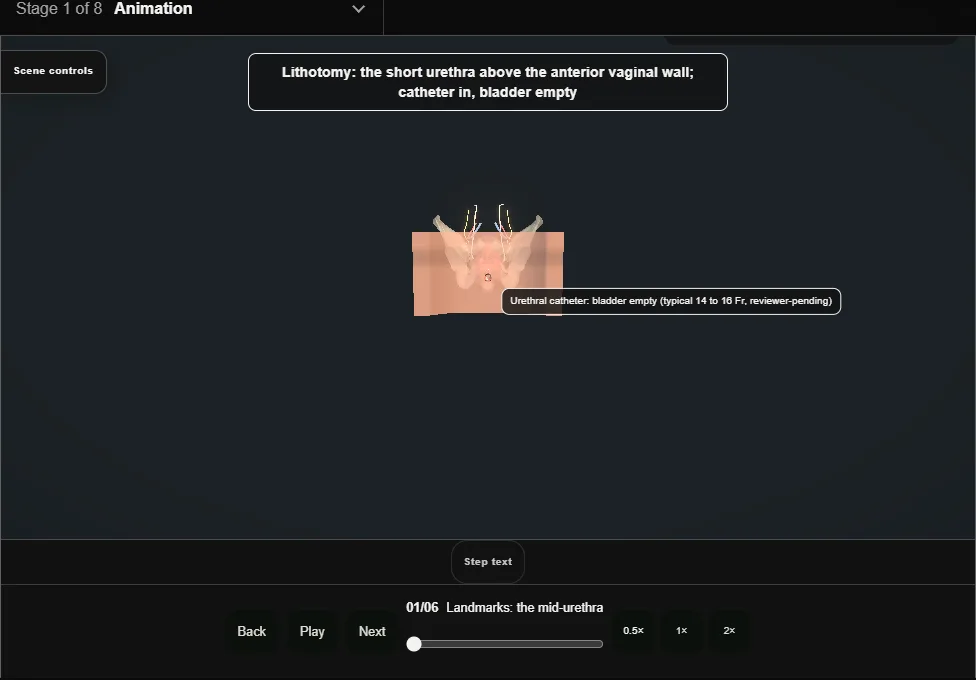Transobturator mid-urethral sling (TOT). Step 1: Landmarks: the mid-urethra. Captured frame from the interactive animation.