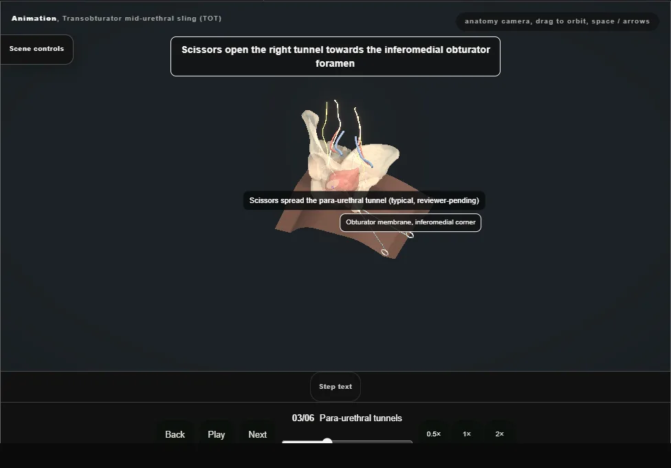 Transobturator mid-urethral sling (TOT). Step 3: Para-urethral tunnels. Captured frame from the interactive animation.