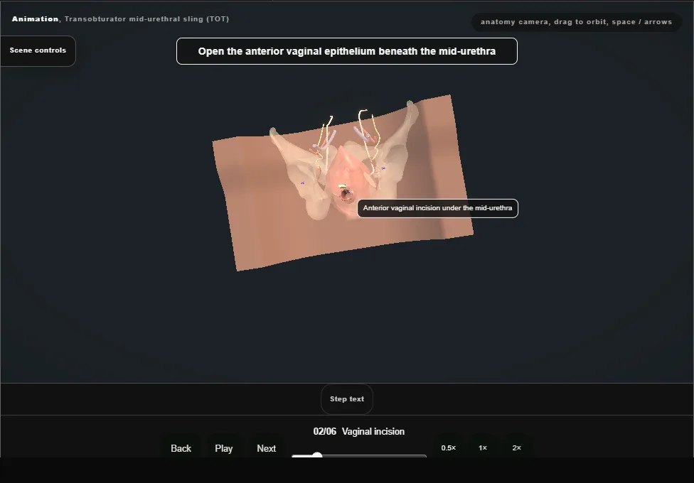 Transobturator mid-urethral sling (TOT). Step 2: Vaginal incision. Captured frame from the interactive animation.