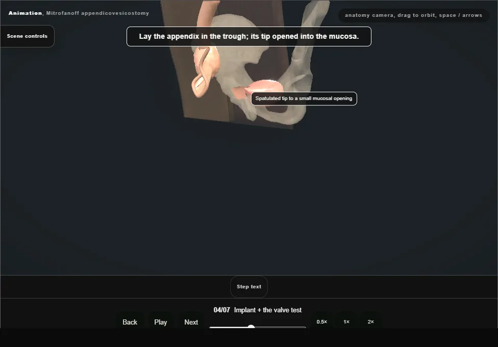 Mitrofanoff appendicovesicostomy. Step 4: Implant + the valve test. Captured frame from the interactive animation.