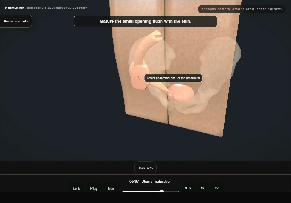 Mitrofanoff appendicovesicostomy. Step 6: Stoma maturation. Captured frame from the interactive animation.