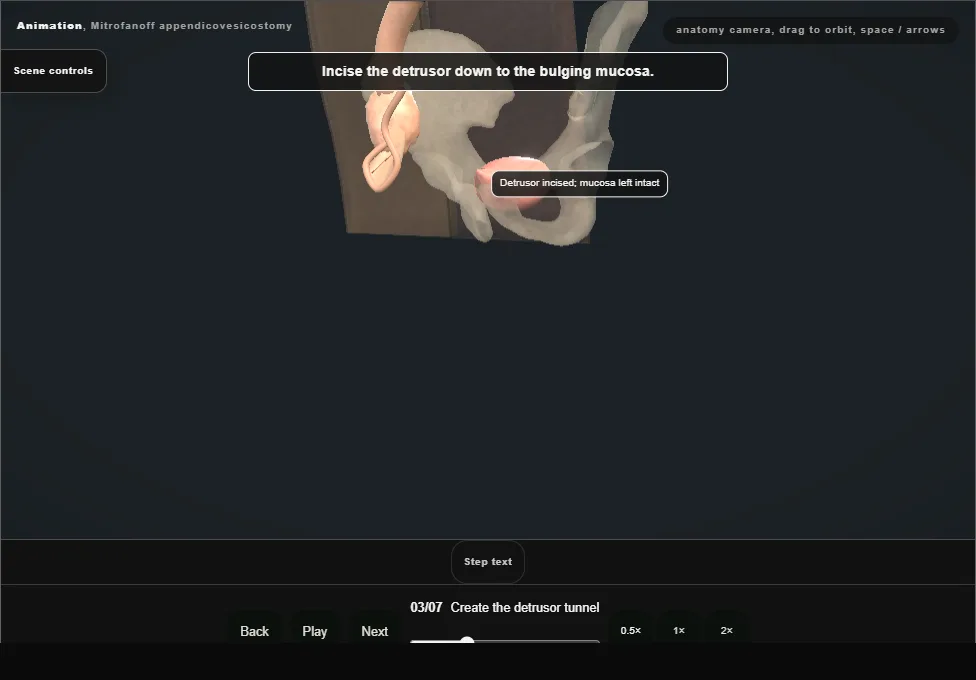 Mitrofanoff appendicovesicostomy. Step 3: Create the detrusor tunnel. Captured frame from the interactive animation.