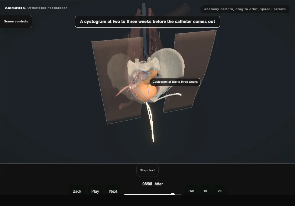 Orthotopic neobladder. Step 8: After. Captured frame from the interactive animation.