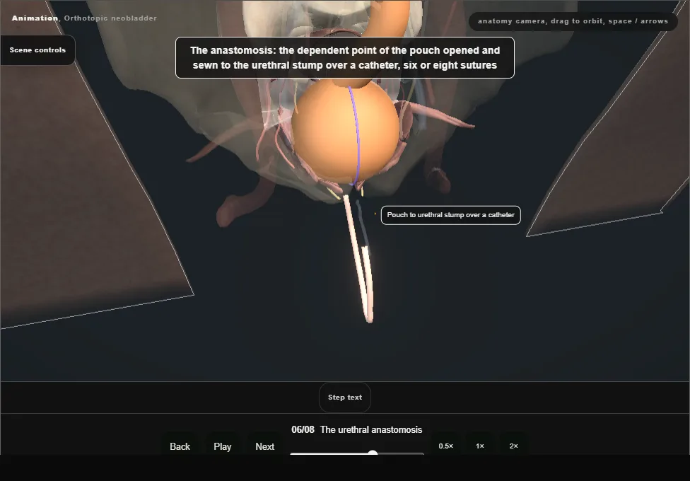 Orthotopic neobladder. Step 6: The urethral anastomosis. Captured frame from the interactive animation.