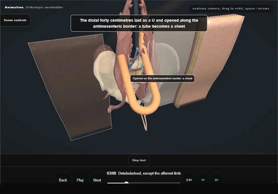 Orthotopic neobladder. Step 3: Detubularised, except the afferent limb. Captured frame from the interactive animation.