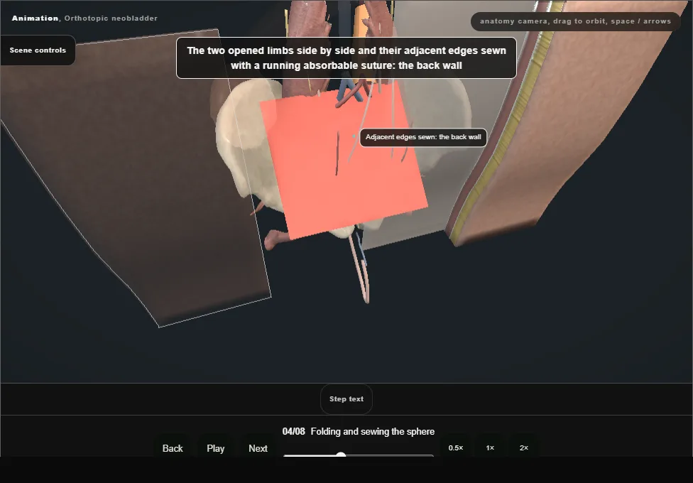 Orthotopic neobladder. Step 4: Folding and sewing the sphere. Captured frame from the interactive animation.